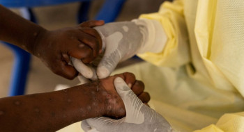 Brasil registra 88 casos de Mpox em 2026; saiba como evitar a doença