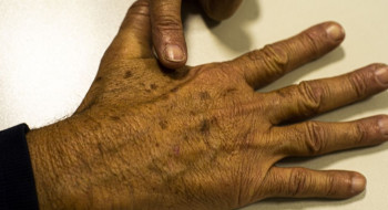 Desinformação sobre câncer de pele afeta diagnóstico, diz instituição