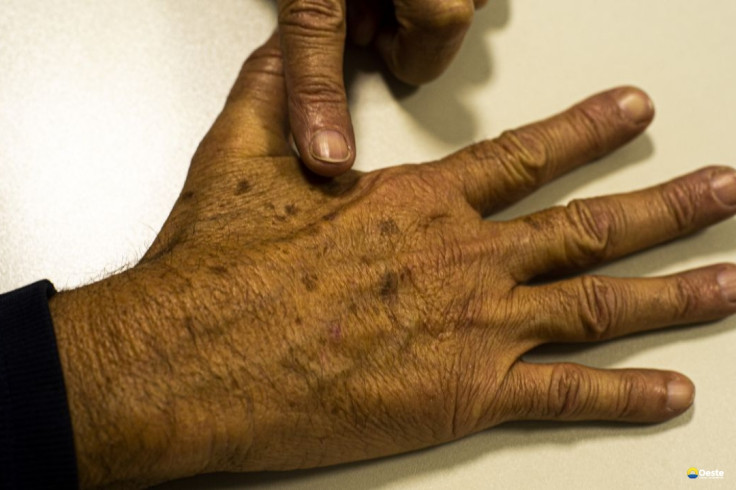 Desinformação sobre câncer de pele afeta diagnóstico, diz instituição