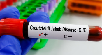 Entenda Doença de Creutzfeldt-Jakob, diagnóstico do piloto Lito Souza