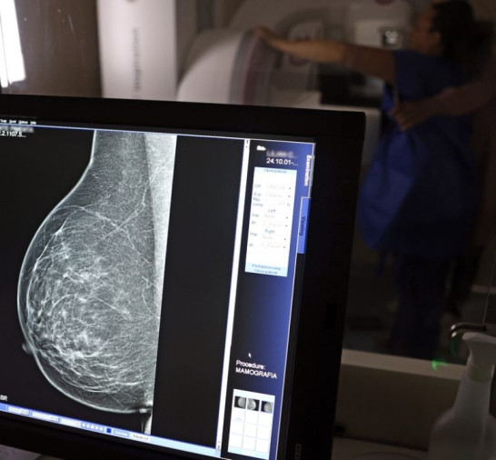Médicos lançam guia para evitar recusa de mamografia digital