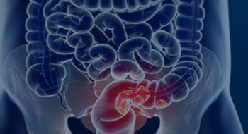 Pacientes com câncer colorretal são diagnosticados em estágio avançado