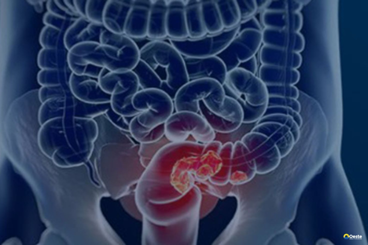 Rastreamento para câncer colorretal pode ser implementado no SUS